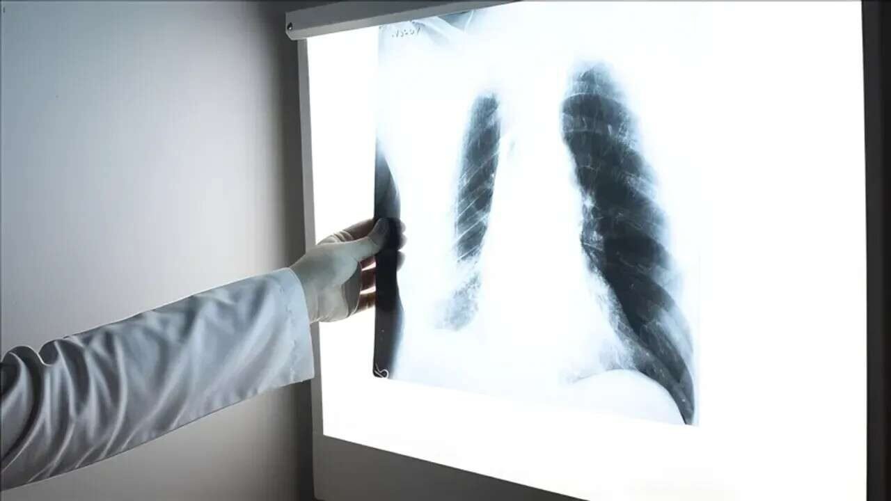 Akciğer kanserinde erken teşhis yaşam şansını yüzde 90’a çıkarıyor
