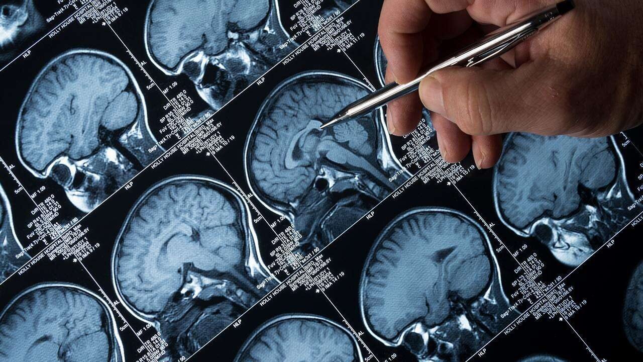 Alzheimer araştırmasında beyin hücrelerini koruyan gençlik proteini bulundu